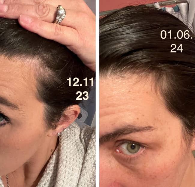 Side-by-side comparison of reviewer's hairline before and after using after one month showing more hair at the temples