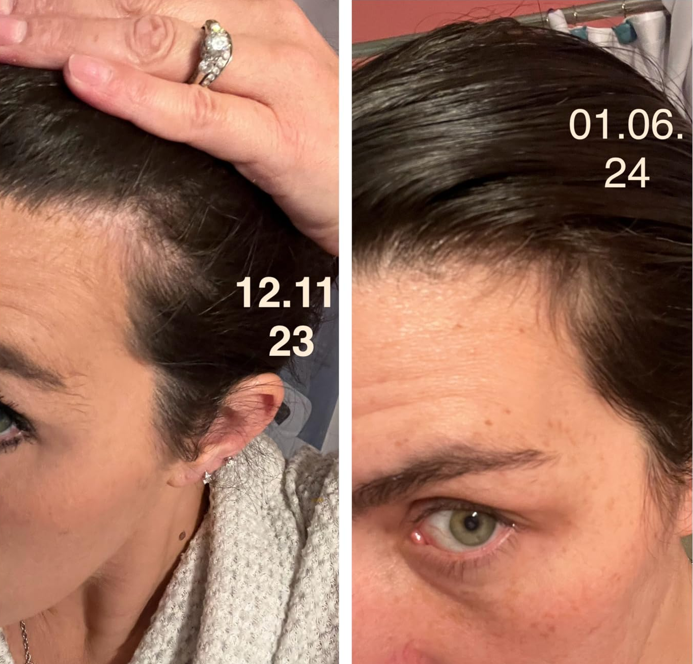 Side-by-side comparison of reviewer's hairline before and after using after one month showing more hair at the temples