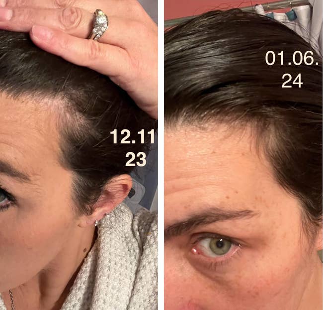 Side-by-side examination of reviewer's hairline earlier and aft utilizing aft 1 period showing much hairsbreadth astatine the temples
