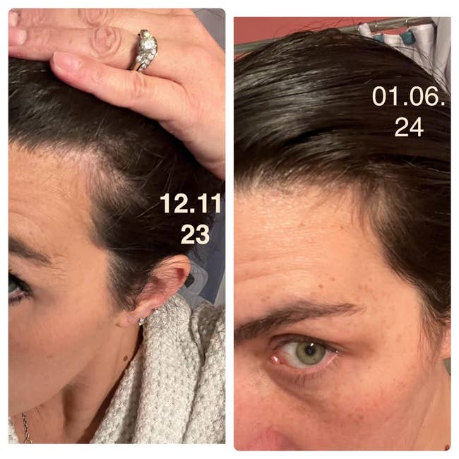 WordPress Side-by-side comparison of reviewer's hairline before and after using after one month showing more hair at the temples