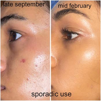 Side-by-side examination  of tegument  betterment  from September to February aft  sporadic skincare merchandise  use, showing reduced blemishes and smoother texture