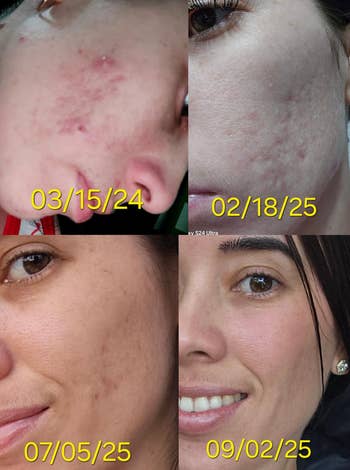 Four close-up images show a woman's facial skin improving over time, dated between 2024 and 2025, highlighting skincare progress