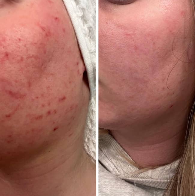 Before and after comparison of reviewer's cheek with red marks faded after using snail mucin