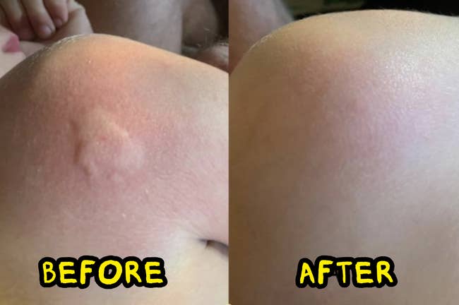 Before and aft  images showing tegument  improvement, with the 