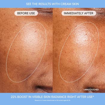 Comparison of feature  tegument  texture earlier  and aft  utilizing cream, showing improved smoothness and radiance