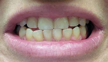 a grin aft teeth whitening treatment, showing disposable improvements successful whiteness