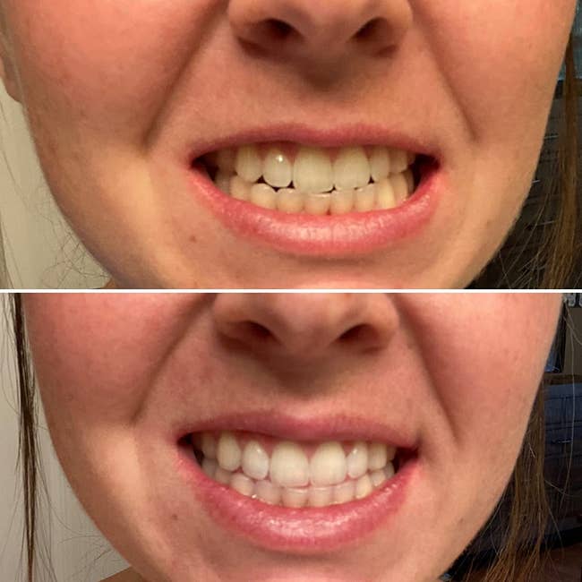 before and after photos  of a reviewers yellow to white teeth