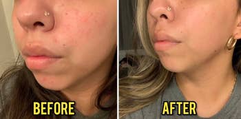 A side-by-side comparison of a reviewer's face before and after skincare treatment with visible improvements in skin clarity