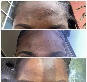 Reviewer's forehead in top photo with cystic acne before using PanOxyl wash, in middle photo with acne clearing after beginning the face wash, and in bottom photo completely clear after consistent usage