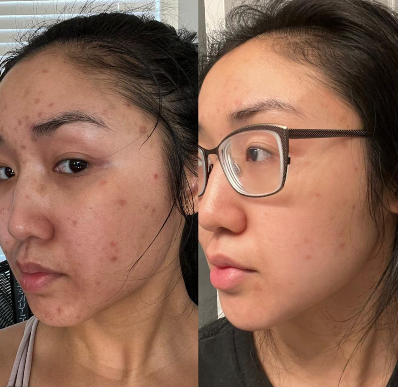 reviewer before and after photo showing how the essence helped fade acne 