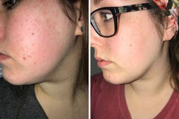 before/after of the moisturizing cream used on a reviewer, showing smoother skin with less redness