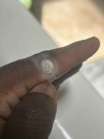 Close-up of a digit with a healing blister, perchance from a pain oregon friction, connected the outer surface