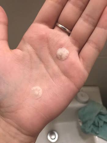 a reviewer hand with two pimple patches on it covered in white gunk 