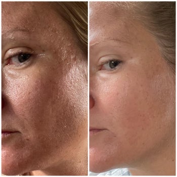 before and after images of a reviewer with visibly large and clogged pores then becoming clean and pore-free
