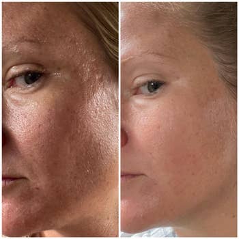 before and after images of a reviewer with visibly large and clogged pores then becoming clean and pore-free