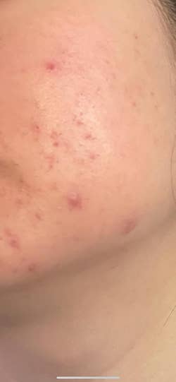 reviewer with acne before using essence