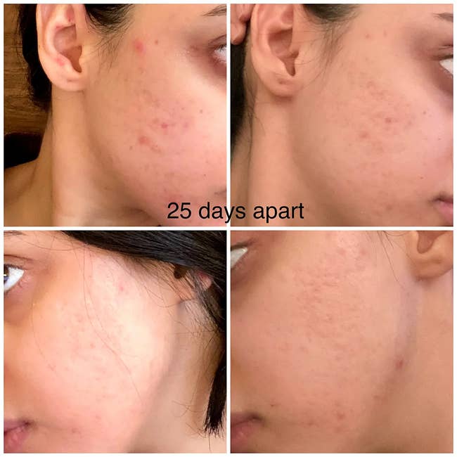 A before photo of a reviewer with lots of acne and acne scars on their cheeks, and an after photo 25 days later showing their cheeks have far fewer breakouts and are less red
