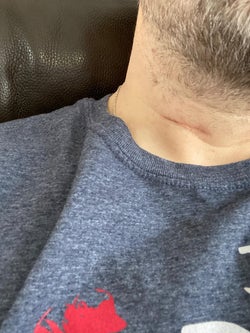 the same reviewer showing the after and how the scar has basically disappeared while using bio-oil