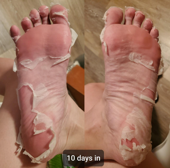 reviewer's feet peeling