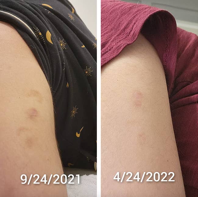 a reviewer's arm scars before and after being significantly lighter after using the oil