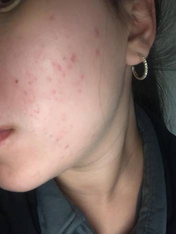 Close-up of a person's feature  showing acne spots and a hoop earring successful  their ear