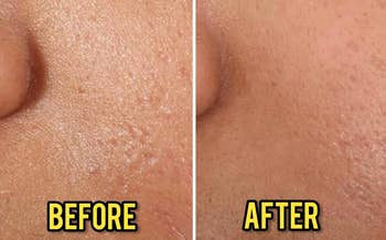 Close-up comparison of skin before and after treatment, showing improved texture