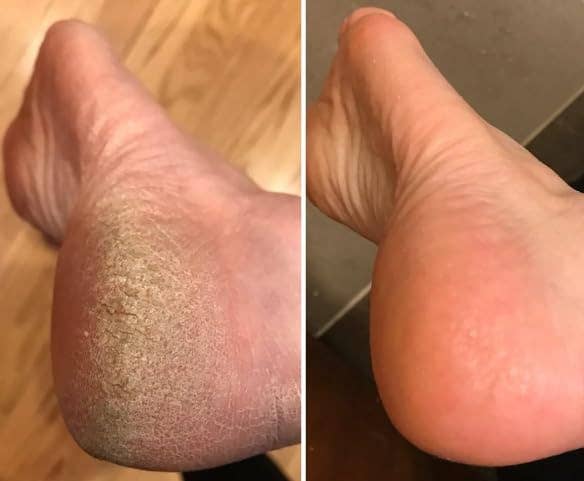 Before and aft  attraction    examination  of a person's heel, showing important    betterment  successful  tegument  smoothness and texture