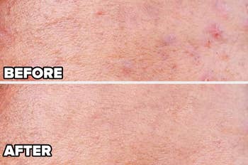 Before-and-after image showing skin improvement, with reduced blemishes and smoother texture after using a skincare product