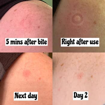 top left to bottom right: the mosquito bite on knee, the same knee with small mark after using the tool, then the mosquito bite decreased in swelling