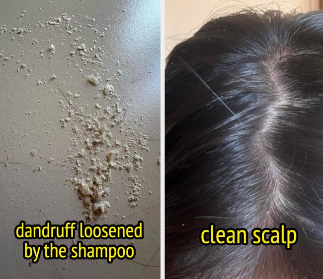 Dandruff flakes connected  a aboveground  contrasted with a clean, dandruff-free scalp, suggesting effectual  shampoo results