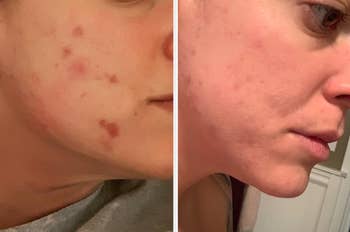 reviewer side by side of their face with red acne and then their soothed breakout