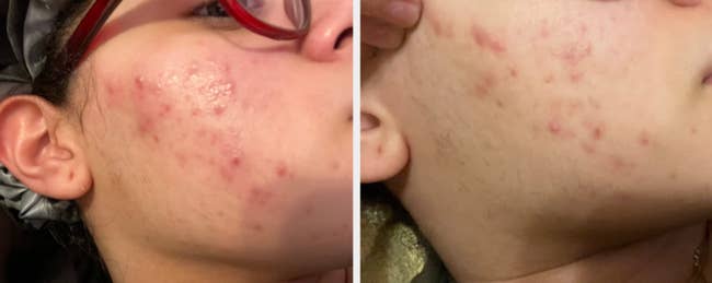 Reviewer with acne and redness / same reviewer with significantly less redness and fewer pimples