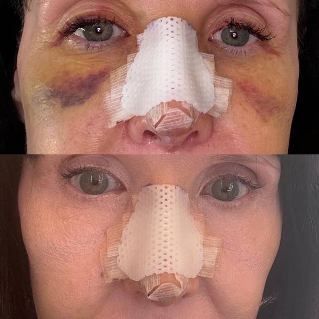 A reviewer before-and-after examination  of bruised nether  eyes earlier  and aft  utilizing brightener