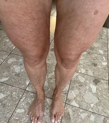 after image of the same reviewer with noticeably less cellulite on legs