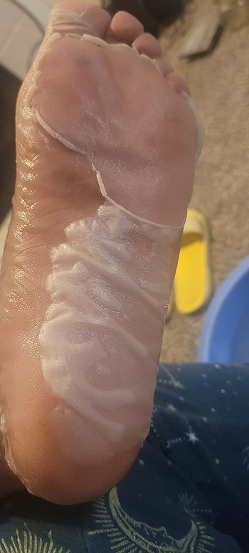 the bottom of reviewer's foot shedding skin