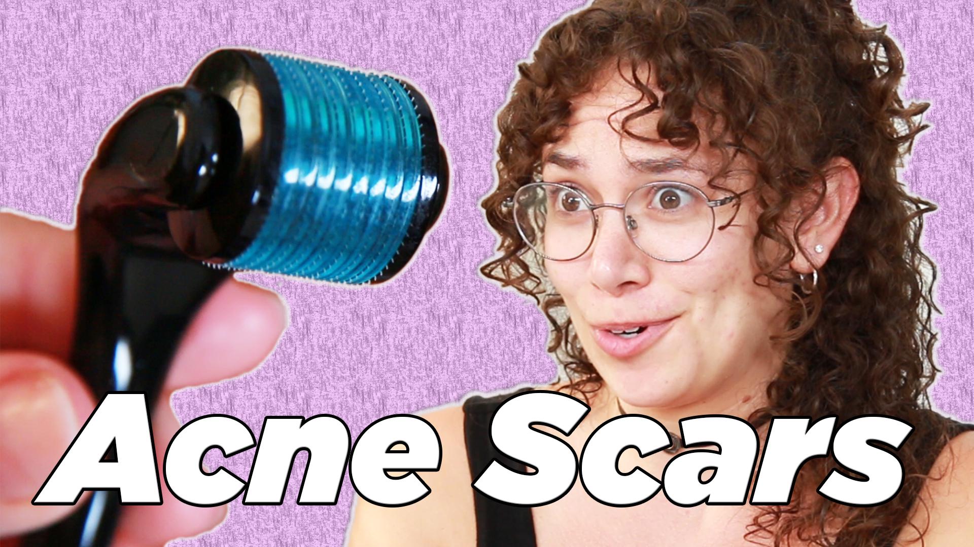 buzzfeed acne scars