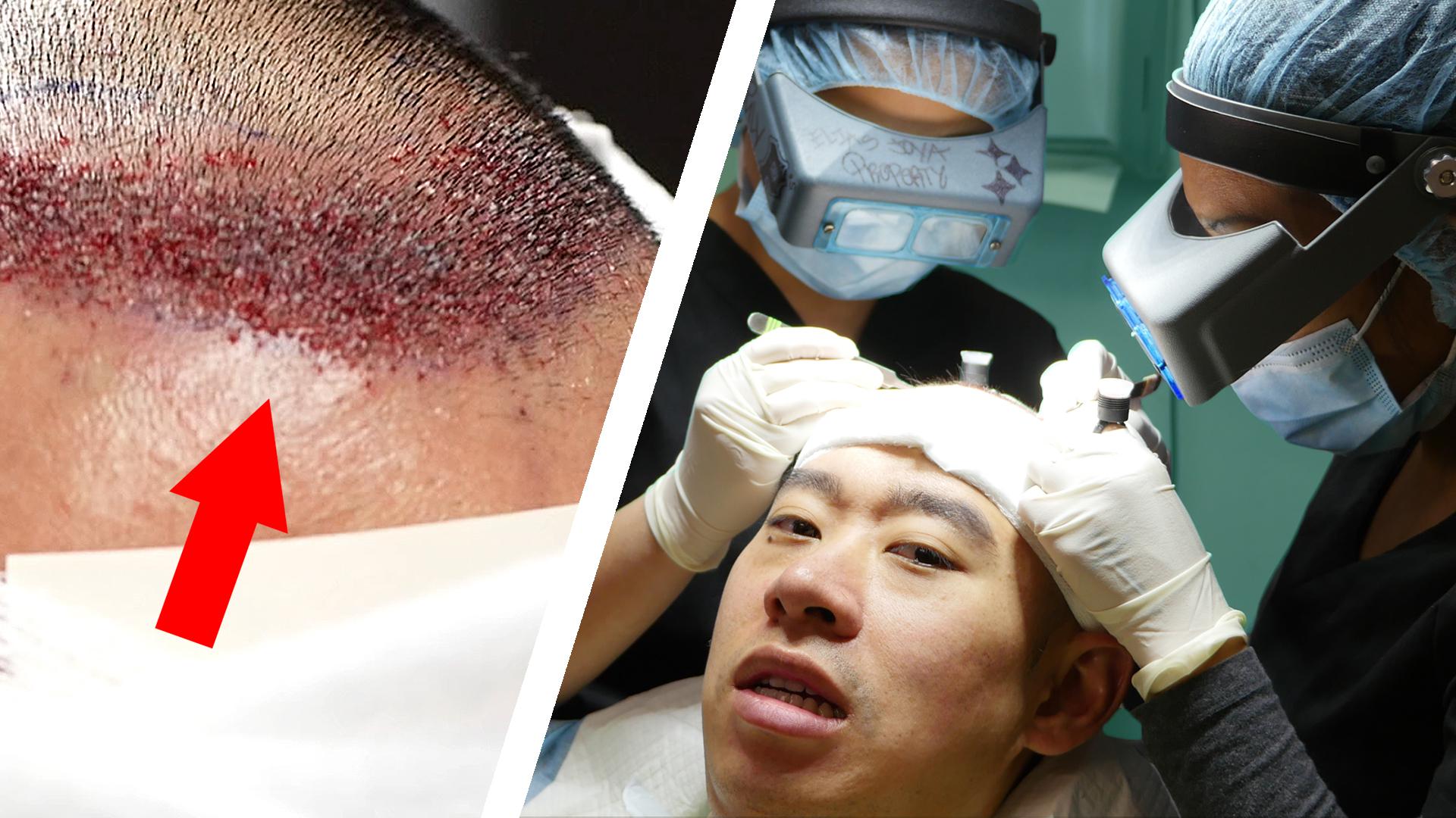 A Bald Man Gets A Hair Transplant
