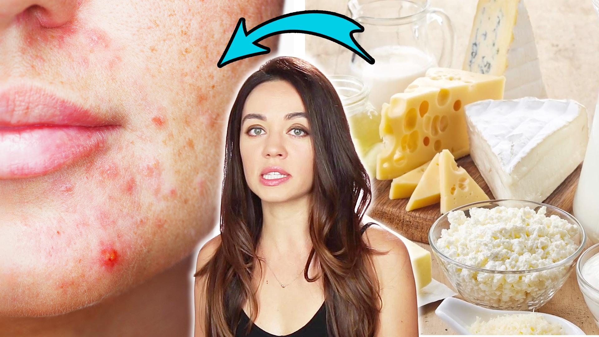 nutritionists-share-surprising-facts-about-how-food-affects-acne